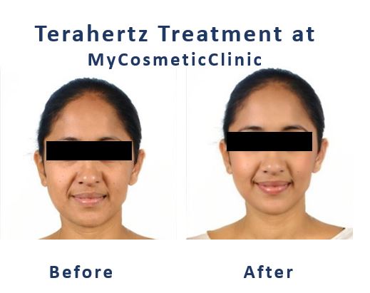 Terahertz-Treatment-Before-After