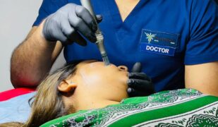 Microneedling treatment for acne_updated