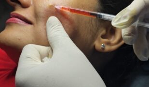 Biostimulators in Aes_updated