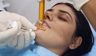 Dermal fillers_updated
