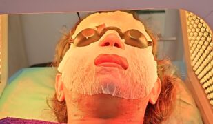 Navigating skin pigmentation Sunburn and hot weather_updated