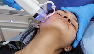 Radio Frequency microneedling_updated
