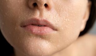 The “Hollywood” way to improve your skin!