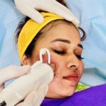 Tired of Acne Scars and Open Pores? MNRF Could Be the Answer