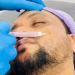 Acne Scars: Why They Form and How Aesthetic Treatments Can Help