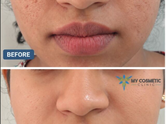 Acne Scar Treatment in Colombo | Subcision, MNRF & PRP