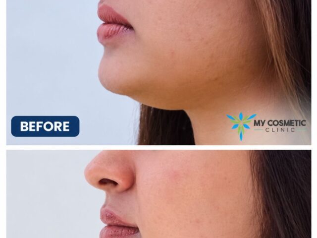 How Can I Get a Sharper Jawline Without Surgery? Jawline Fillers, HIFU & Fat-Dissolving Treatments in Colombo