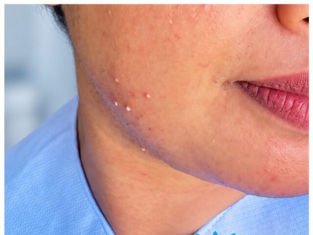 Laser Hair Reduction in Colombo | Doctor-Led Treatment