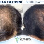 PRP, GFC & PRF Hair Treatment in Colombo | Dr Harsha Jayakody