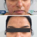 Why Do Pimples Keep Coming Back? Doctor-Led Acne Treatment in Colombo